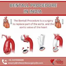 Low Cost Bentall Procedure India