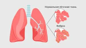 Операция по пересадке сердца